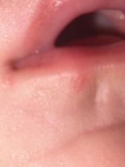 Do these spots look like a cold sore in a child?