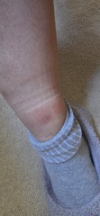 Suspected flea bites?