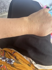 Weird rash and bumps