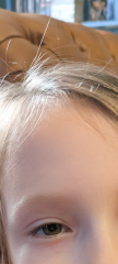 Ezcema help please