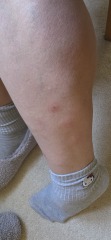 Suspected flea bites?