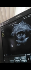 Any guesses on the nub from my pregnancy scan?