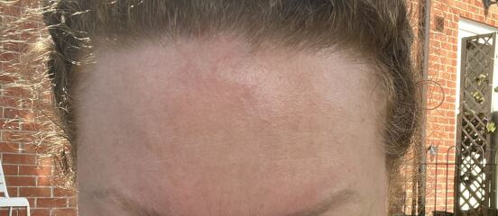 AIBU to consider Botox for forehead lines at 40?