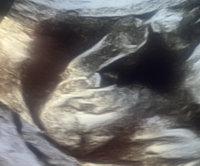 Conflicting scan results on baby's sex at 22 weeks