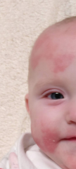 Ezcema help please