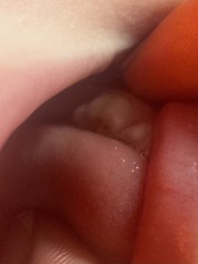 3.5 year olds teeth