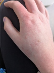 Any idea what this is on my hand? (Photo)