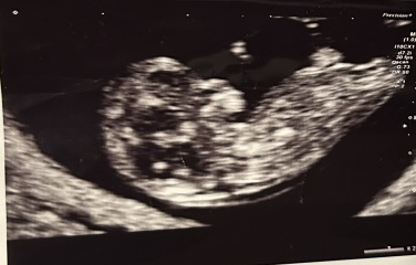 Boy or girl guesses based on skull theory at pregnancy scan