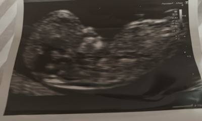 Boy or girl guesses based on skull theory at pregnancy scan