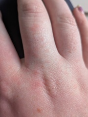 Any idea what this is on my hand? (Photo)