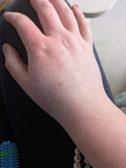 Any idea what this is on my hand? (Photo)