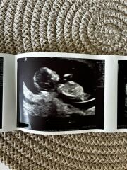 Girl or boy ? 🤍 ultrasound pic