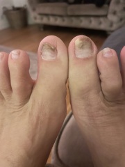 Black toenails