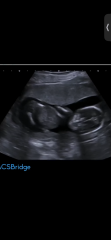 Still nauseous at 18 weeks and wondering about nub theory