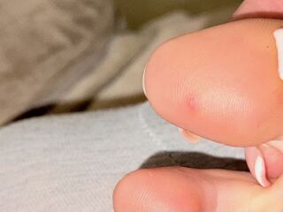 Weird rash on my toes & other symptoms anyone else had this?