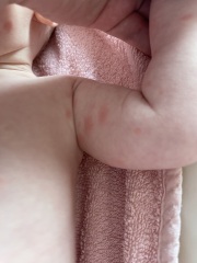 AIBU to worry about rash spreading after 12 week jabs?