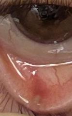 Is this a stye or a chalazion?  Back to pharmacist?