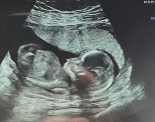 Cleft lip