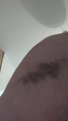 AIBU to ask if this arm wound needs attention? Contains a bloody pic of said wound