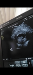 Any guesses on the nub from my pregnancy scan?