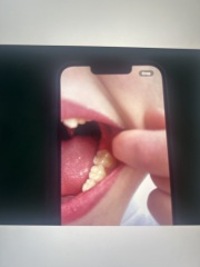 Dentist… Molar incisor hypomineralisation