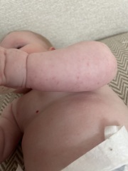 Does this look like heat rash?