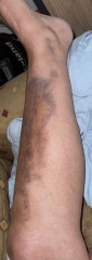 Advice to help the bruising go down pics included