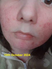 What's this weird rash on my face I've had for years?