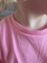 Is this chickenpox pox
