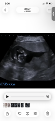 Still nauseous at 18 weeks and wondering about nub theory