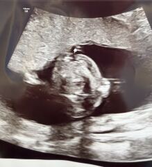 Cleft lip