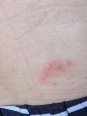 Does this rash look like shingles or just an insect bite?