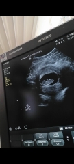 Any guesses on the nub from my pregnancy scan?
