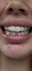 Unsure on Invisalign results