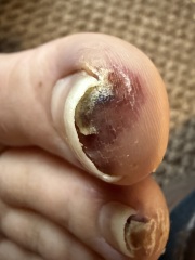 Weird rash on my toes & other symptoms anyone else had this?