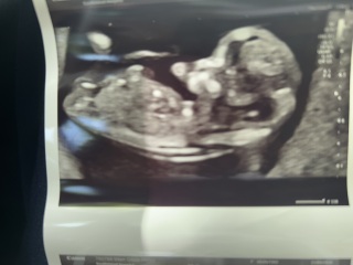 Pregnancy nub and skull theory guesses: boy or girl?