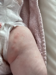 AIBU to worry about rash spreading after 12 week jabs?