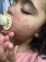 Daughter woke with a rash on her face, has anyone seen this?