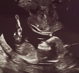 Can anyone please help guess our baby’s sex from a 13 week scan?
