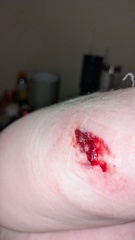 AIBU to ask if this arm wound needs attention? Contains a bloody pic of said wound