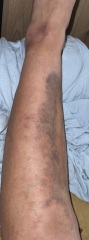 Advice to help the bruising go down pics included