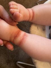 10 month old with a really bad rash! Any idea what it looks like/ could be and desperate for some home remedies.