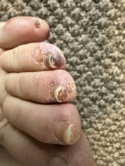 Weird rash on my toes & other symptoms anyone else had this?