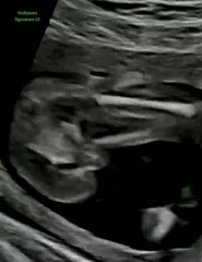 17 week potty shots. Confused. Please help!