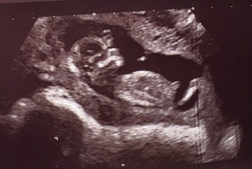 Going down a rabbit hole with nub theory (yes I know I am crazy) - Is this definitely a boy!