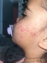 Daughter woke with a rash on her face, has anyone seen this?