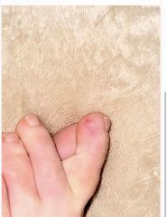 Weird rash on my toes & other symptoms anyone else had this?
