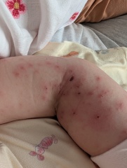 Chicken pox - is this normal?!