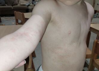 Allergy test for 2 yr old?