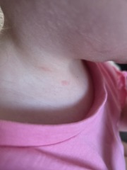 Is this chickenpox pox
